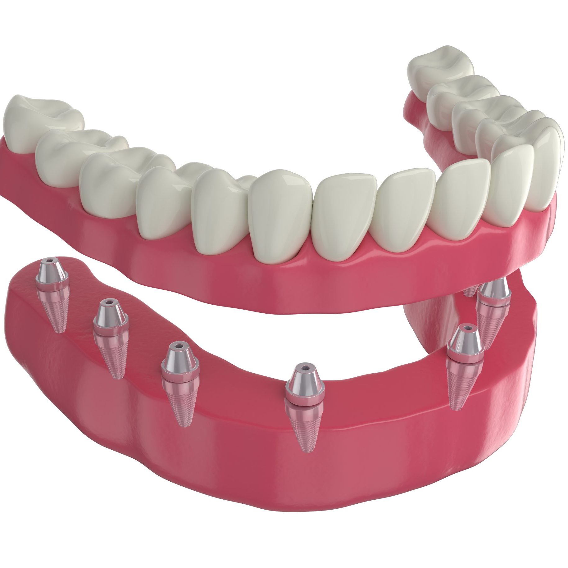 dental-prosthesis-8-overdenture-implants-lower-arch-3d-render