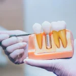 types of dental implants