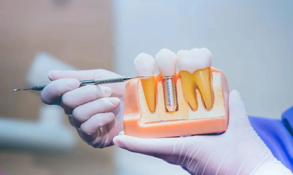 types of dental implants